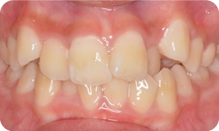 八重歯が気になる症例 治療前の写真