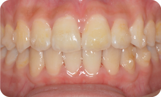 八重歯が気になる症例 治療後の写真