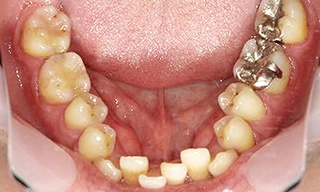 下の前歯がガタガタな症例 治療前の写真