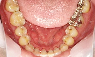 下の前歯がガタガタな症例 治療後の写真