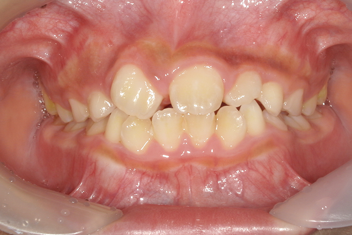 Before